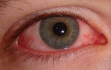 zánět spojivek, alergická konjunktivitida, oči, oční alergie