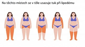 Lipedém je něco jiného než obezita. Léčí se dietou, speciálním prádlem a liposukcí