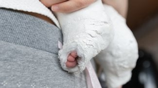 Dětem s golfovou nohou pomáhá Ponsetiho metoda. Nemusí na spoustu velkých operací