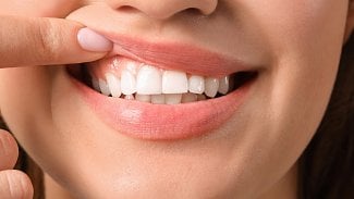 Špatný stav dásní může způsobit řadu nemocí, ztráta zubů je jen začátek
