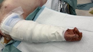 V Brně lékaři přišili zcela amputovanou ruku. Muži ji utrhl stroj