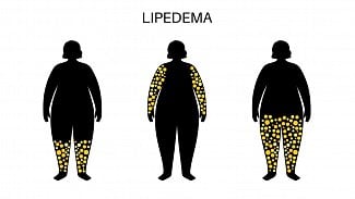 Lipedém, kterým trpí Monika Bagárová, se týká každé desáté ženy. Léčí se i liposukcí