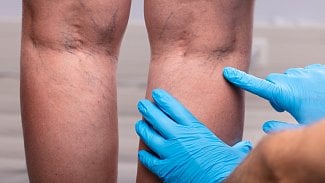 Křečové žíly řeší jednodenní chirurgie. Na rekonvalescenci většinou stačí týden