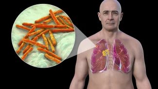 Pacientů s tuberkulózou přibývá, lékaři chtějí oddělení pro léčbu odolné formy