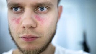 Systémový lupus má negativní vliv na celý organismus.Vyléčit nejde, ale dají se zmírnit příznaky