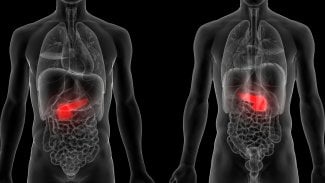 Vyhledávat pacienty s rakovinou slinivky bude 500 praktiků. Diabetiky v riziku čeká CT vyšetření