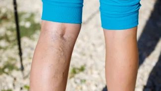 Lidé chodí se žilami k lékaři o 10 let později, než by bylo kvůli léčbě potřeba