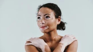 Vitiligo je porucha pigmentace kůže. U pacientů ale zanechává také šrámy na duši