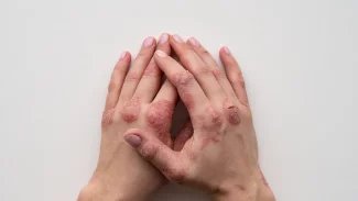 Lupénka je projevem narušené imunity. Vyvolat ji může infekce, silný stres i puberta
