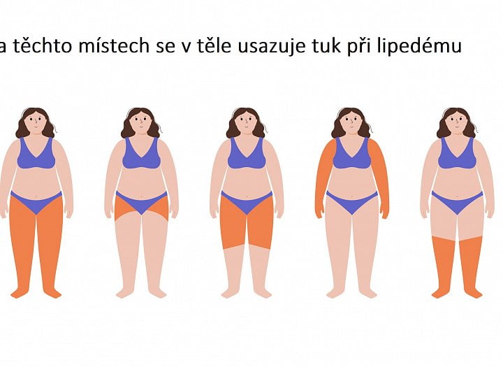 Při lipedému se v těle hromadí tuk, většinou na nohách, ale může to býti jinde