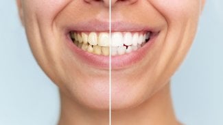 Náhledový obrázek - Žloutnutí zubů: částečně je dáno stárnutím. Nejlépe lze odstranit profesionálním bělením