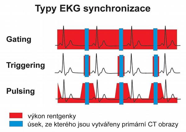 Obr. 1 – Typy EKG synchronizace s ohledem na skenování a následné rekonstrukce ze získaných dat. Podrobněji v textu.