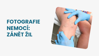 Náhledový obrázek - Zánět žil obrázky: jak nemoc vypadá a jaká jsou s ní spojená rizika?