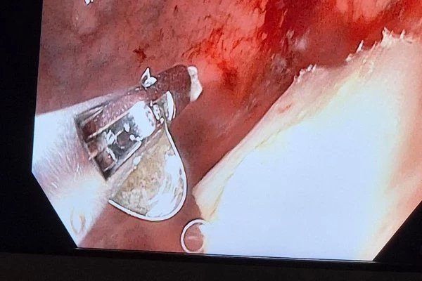 Fotka z endoskopické kamery - dítě spolklo kovový plíšek z produktů ze zahřívaného tabáku