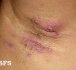 Hidradenitida je chronické autoimunitní onemocnění způsobující rozsáhlé a obtížně léčitelné rány ve formě bolestivých abscesů nebo bulek.