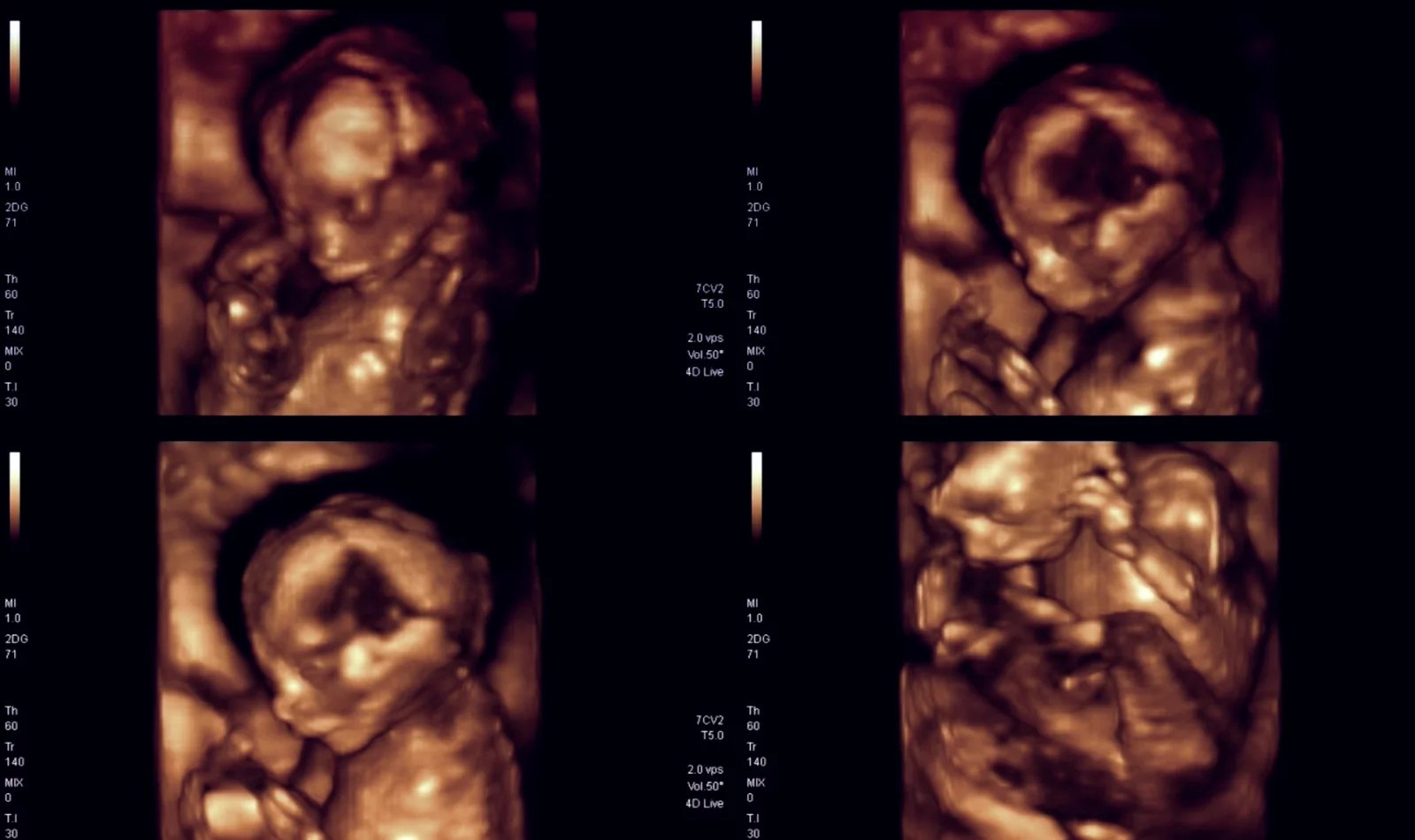 Nejnovější zobrazovací technika 4D ultrazvuk umožňuje vytvářet pohyblivá videa dítěte. Rovněž umí snímat detailněji rysy tváře.