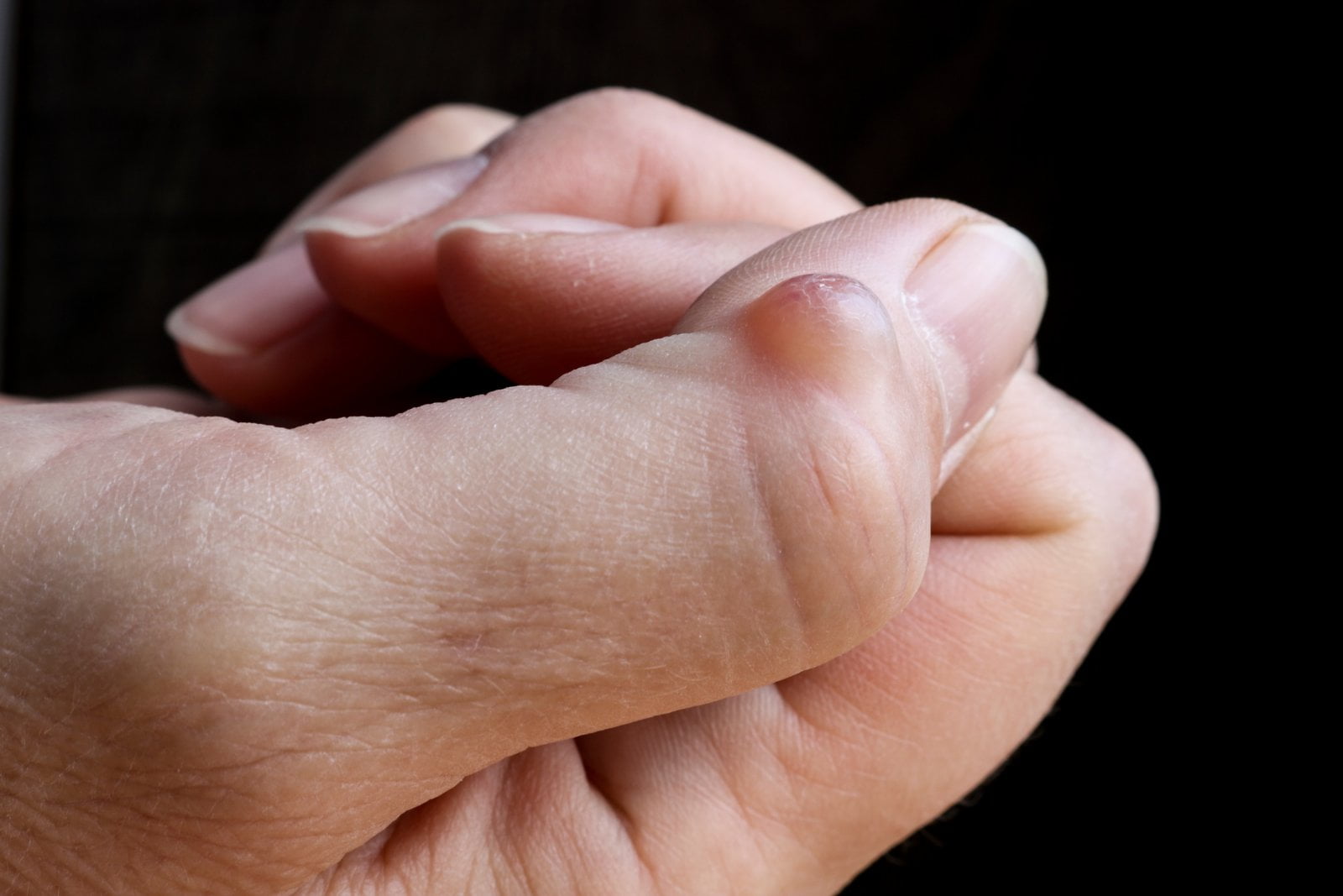 Ganglion se může udělat i u kloubu na prstu
