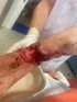 Nejdřív ze všeho chirurgové sešili všechny nervy zásobující ruku a obě vyživující cévy. Pak všech jedenáct šlach ohýbačů prstů a zápěstí a tři šlachy natahovačů palce a zápěstí.