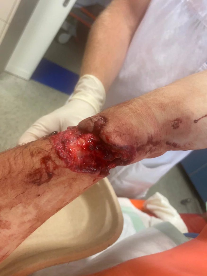 Nejdřív ze všeho chirurgové sešili všechny nervy zásobující ruku a obě vyživující cévy. Pak všech jedenáct šlach ohýbačů prstů a zápěstí a tři šlachy natahovačů palce a zápěstí.