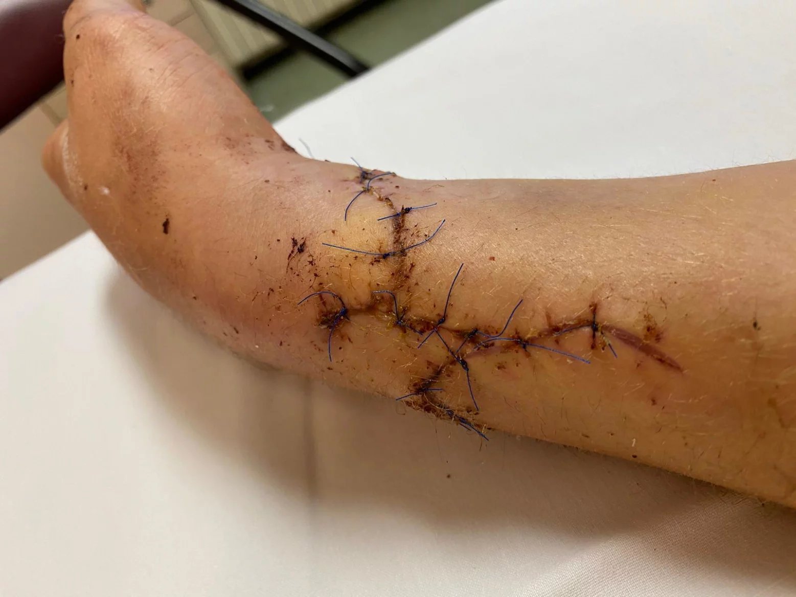 Následovaly další operace, během nichž byly postupně uvolněny nervy a šlachy a také byl opakovaně proveden regenerační lipografting.