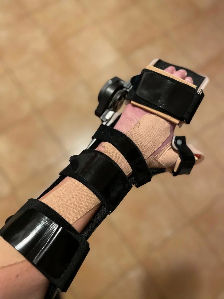 Rehabilitace byly náročné a velmi komplexní. Šlo o individuální fyzioterapii, vodoléčbu a elektroléčbu včetně elektroakupunktury na snížení bolestí, udržení schopnosti kontrakce denervovaných svalů, podporu regenerace zraněných tkání, a především na zlepšení motoriky ruky.