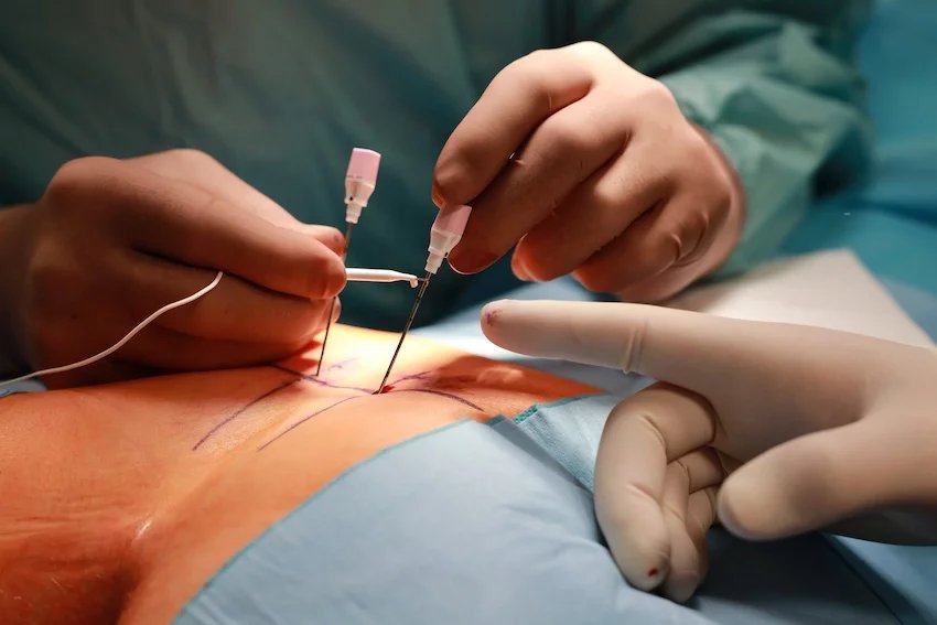 Zavedení neurostimulátoru pro léčbu inkontinence