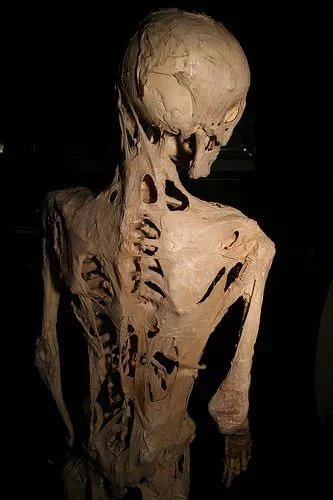 Kostra Harryho Raymonda Eastlacka, který trpěl FOP (Mütterovo muzeu ve Filadelfii)