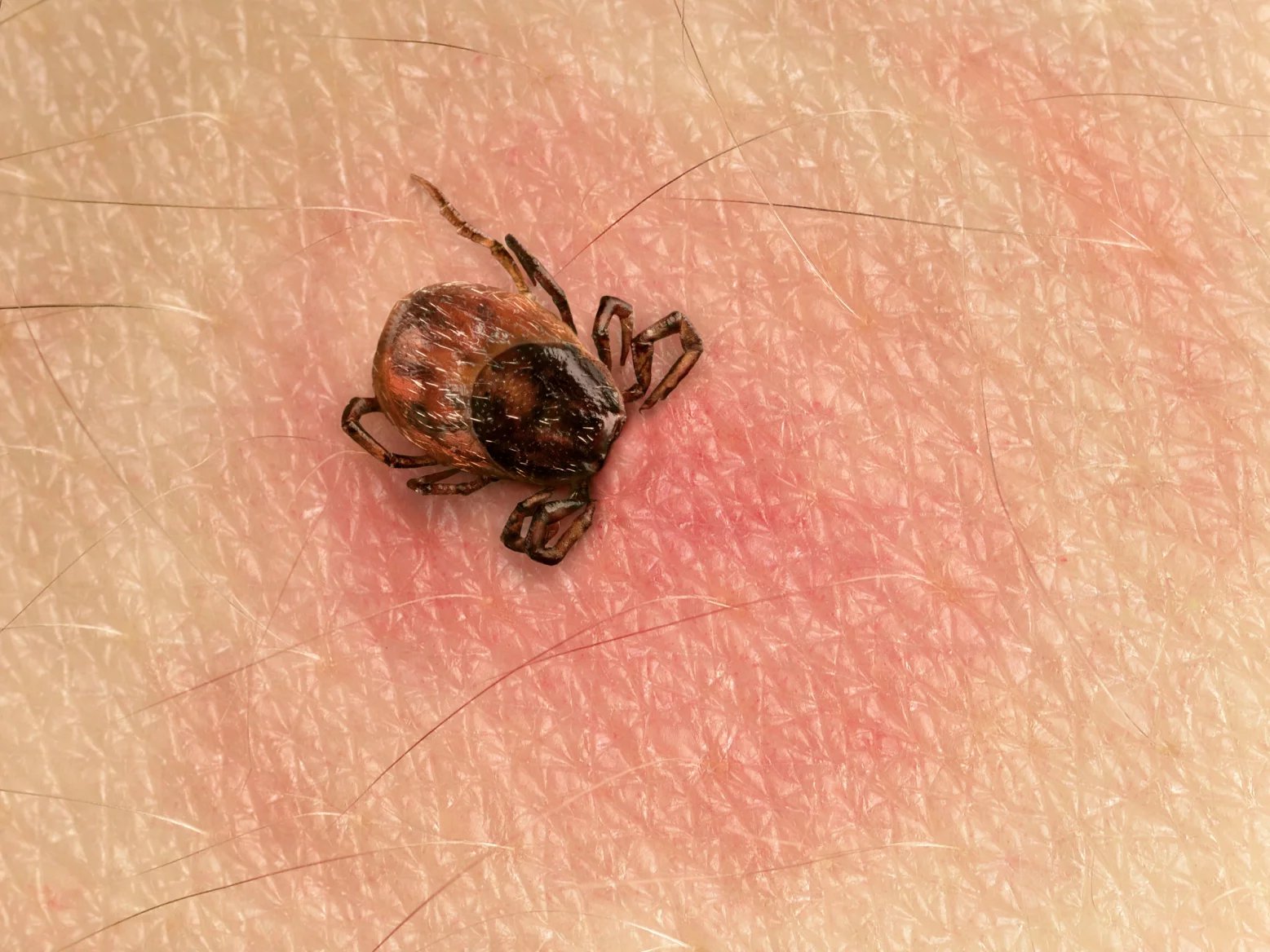 Prvotním příznakem boreliózy je typický flek se světlým středem v místě výskytu klíštěte. Nemoc pak postihuje nervovou soustavu, srdce nebo muskuloskeletální systém.