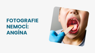 Náhledový obrázek - Angína foto krku: podle těchto příznaků nemoc poznáte. Charakteristické jsou čepy na mandlích