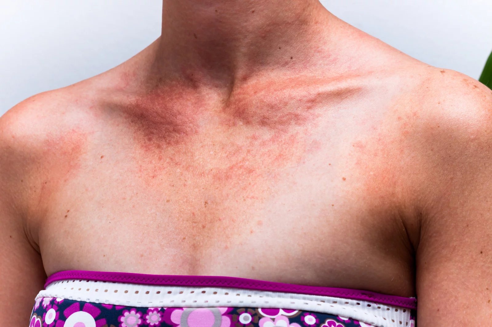 Mezi další symptomy, které jsou pro růži charakteristické, patří především horečka. Tu může občas doprovázet zimnice a dále je to třes, celková slabost anebo problémy trávicí soustavy.
