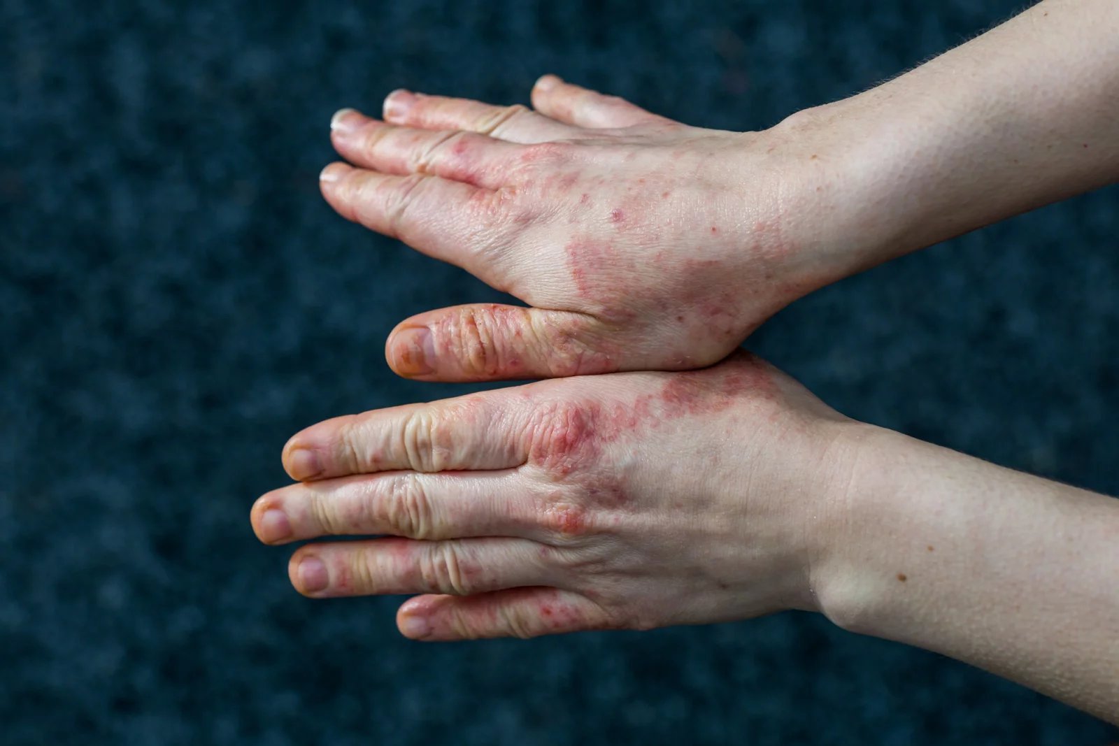 Růži můžete částečně předcházet, respektive můžete několika opatřeními eliminovat nebezpečí jejího vzniku. Mezi tato preventivní opatření patří třeba důkladná hygiena ran, kam spadá pravidelná desinfekce.