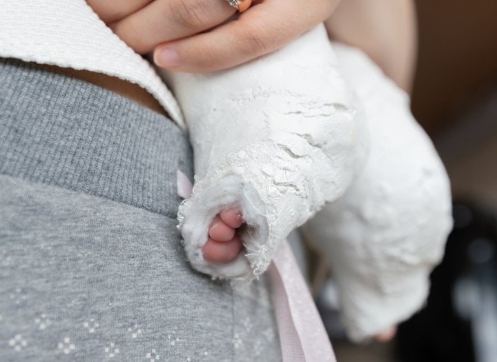 Ponsetiho metoda při léčbě golfové nohy