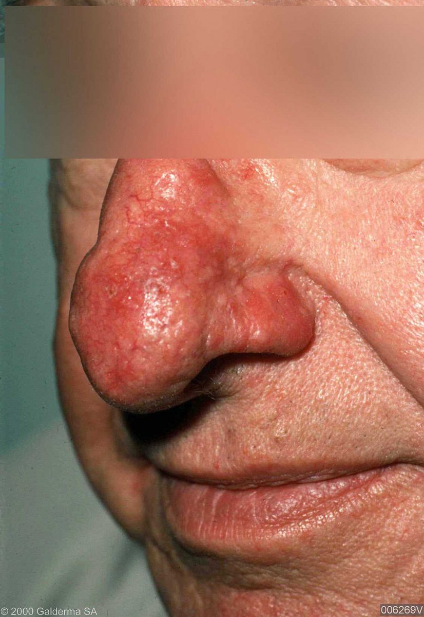 Rosacea (růžovka)