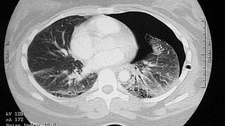 Náhledový obrázek - Nové CT umožní lékařům kvalitnější vyšetření pacienta