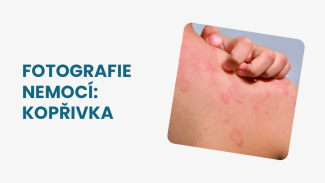 Náhledový obrázek - Kopřivka foto: podívejte se, jakou podobu může mít toto kožní onemocnění v každém věku