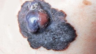 Náhledový obrázek - Vědci objasnili působení buněk melanomu, je to krok k novému léku