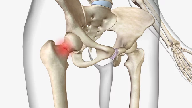 Osteoporóza nejčastěji láme zápěstí a krčky. Jak zlomeninu poznat a k čemu je to dobré