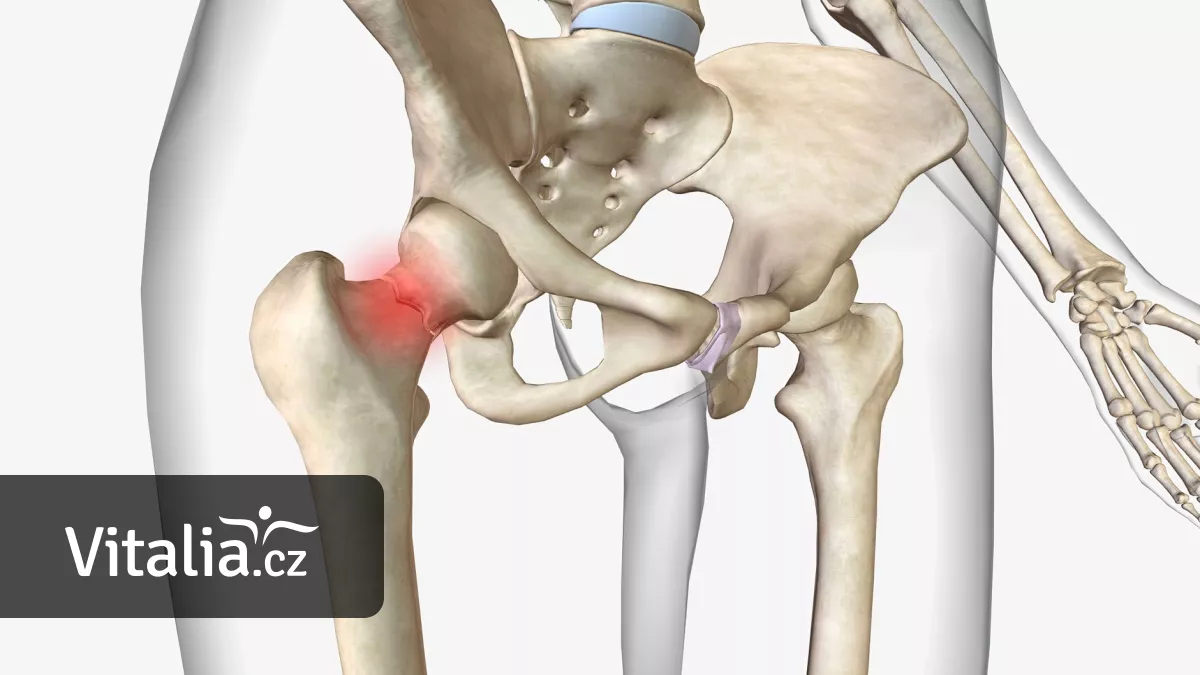 Osteoporóza nejčastěji láme zápěstí a krčky. Jak zlomeninu poznat a k čemu je to dobré