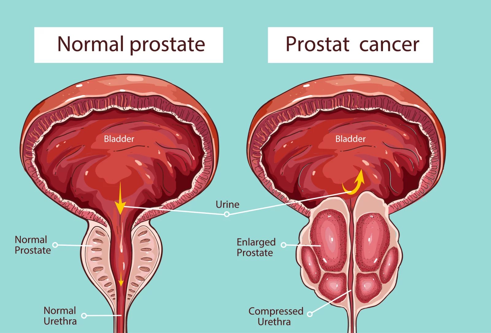 Vlevo normální prostata, vpravo zhoubný nádor prostaty