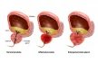 Nezhoubné zvětšení prostaty - benigní hyperplázie