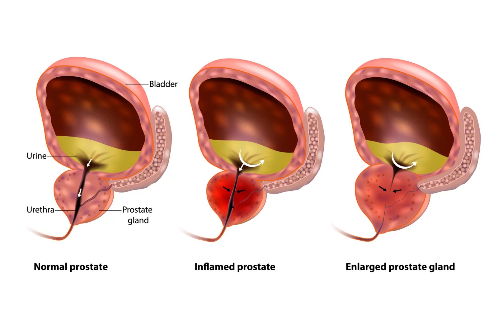 Nezhoubné zvětšení prostaty - benigní hyperplázie