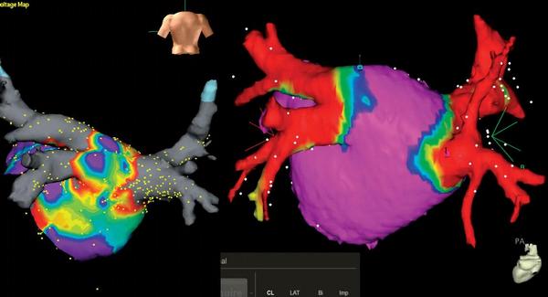 Obr.
1 – Elektroanatomická voltážová mapa levé síně v 3D zobrazení s obrazem ablačních linií periostiálně, vlevo zobrazení systémem NavX (SJM Inc.), vpravo CARTO 3 (Biosense-Webster Inc).