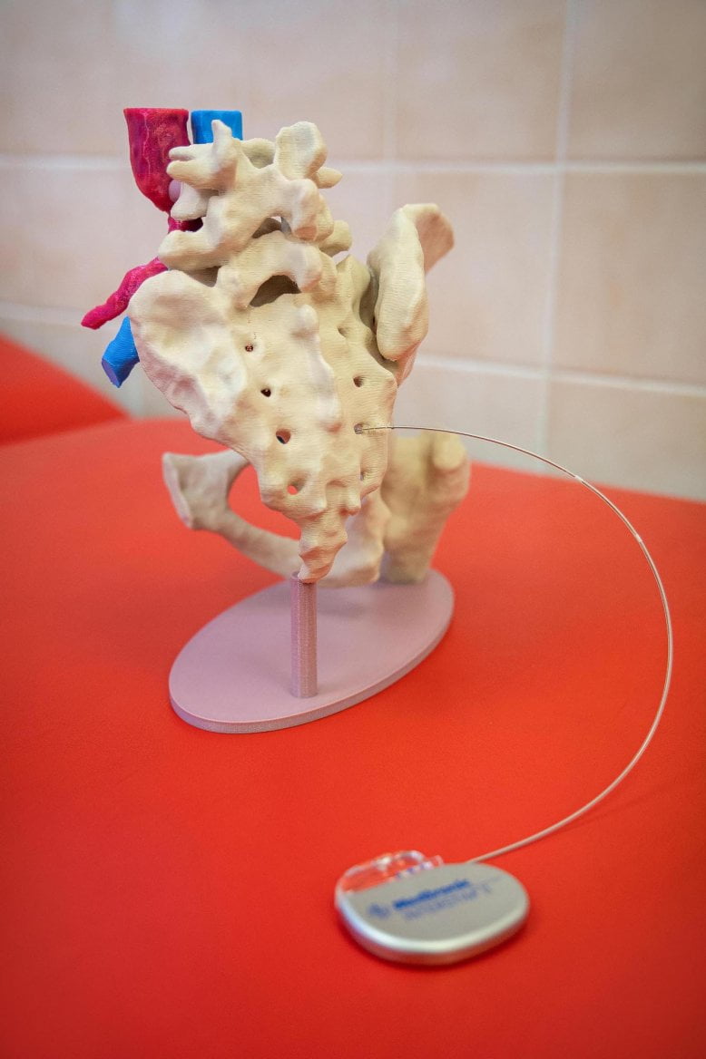 Sakrální neuromodulace k léčbě střevní inkontinence