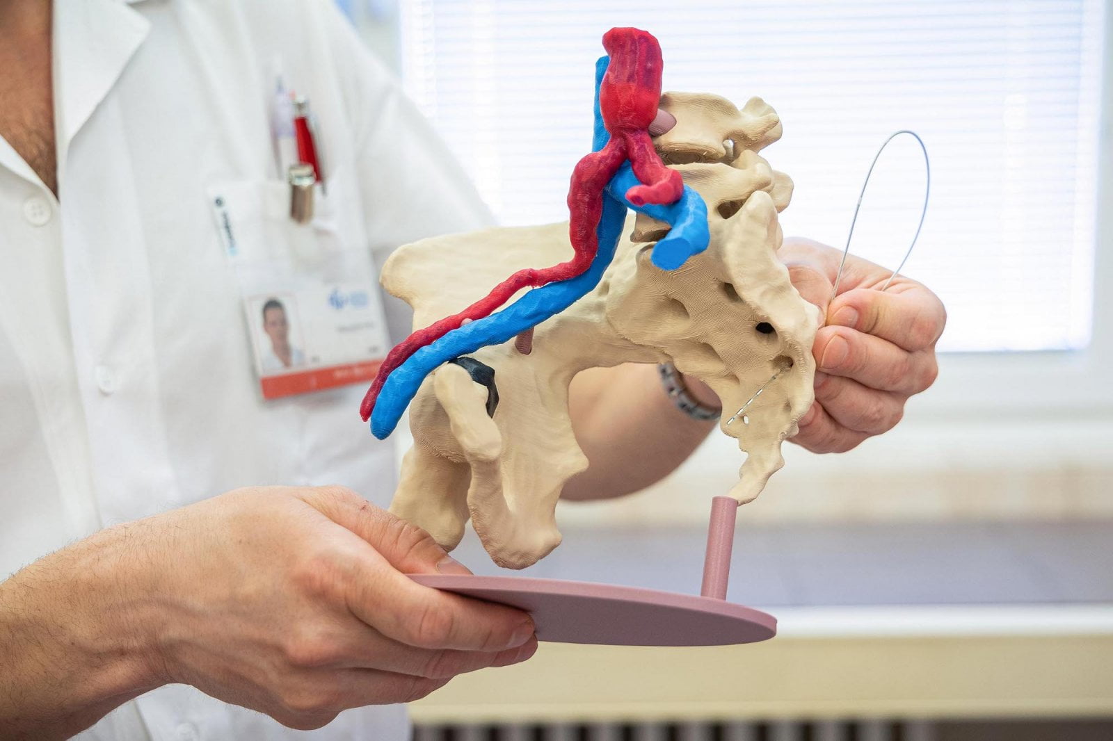 Sakrální neuromodulace k léčbě střevní inkontinence