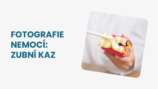 Náhledový obrázek - Jak vypadá kaz na zubu: v počáteční fázi se projevuje jako nepatrná světlá skvrna, později je znatelnější