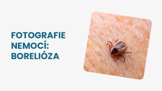 Náhledový obrázek - Borelióza fotografie: jak vypadá skvrna typická pro toto onemocnění?