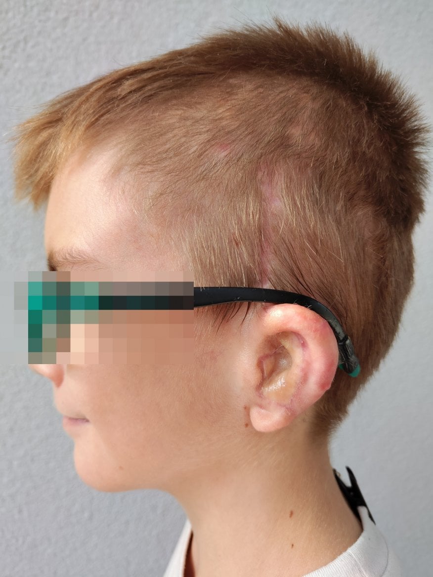 Tomáš, první dítě odoperované v ČR metodou Sheryl Lewinové