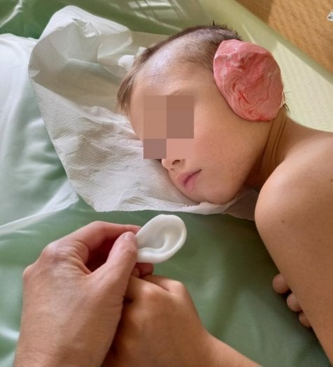 Jonáš, druhé dítě odoperované v ČR metodou Sheryl Lewinové