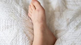 Granulom bývá následkem infekce či chronického zánětu. Běžně se objevuje při tuberkulóze či sarkoidóze