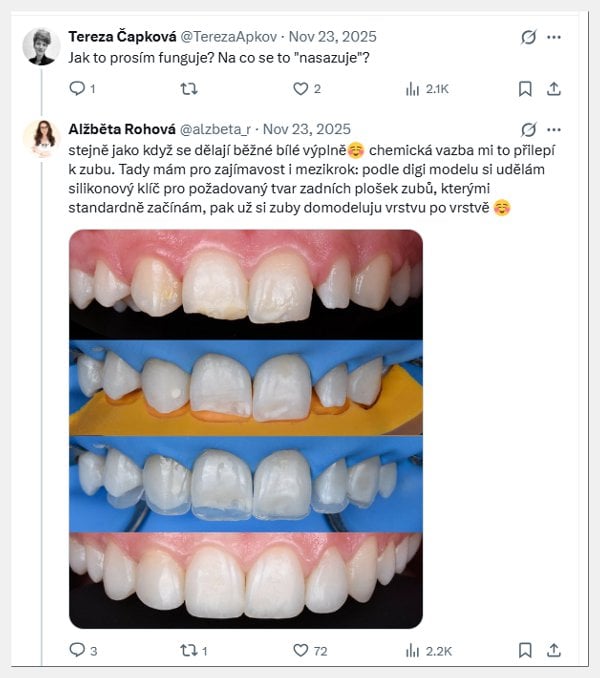 Dostavba chrupu fotokompozitem u 16leté pacientky